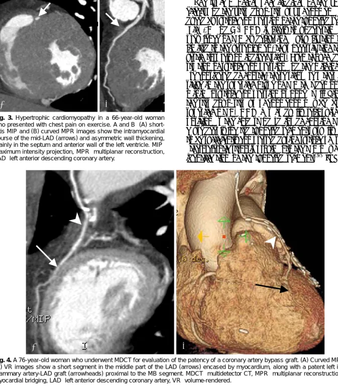 Fig. 4. A 76-year-old woman who underwent MDCT for evaluation of the patency of a coronary artery bypass graft