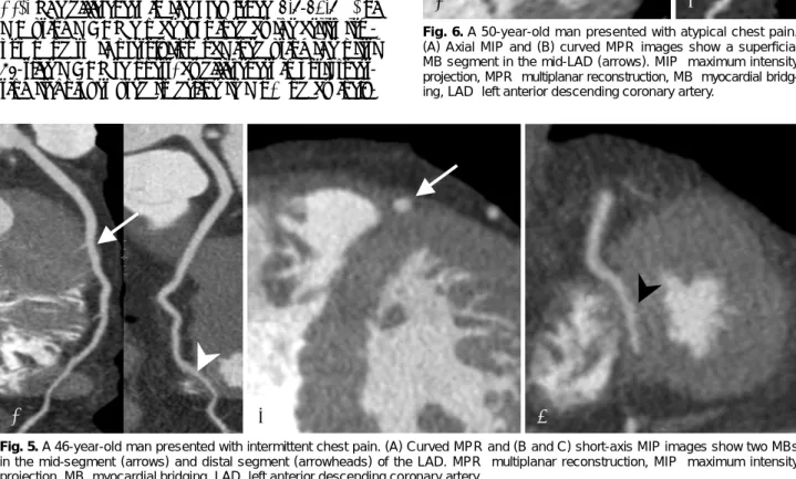 Fig. 5. A 46-year-old man presented with intermittent chest pain. (A) Curved MPR and (B and C) short-axis MIP images show two MBs  in the mid-segment (arrows) and distal segment (arrowheads) of the LAD