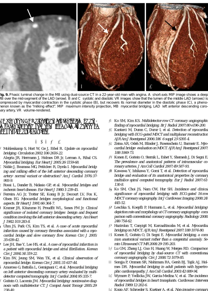 Fig. 9. Phasic luminal change in the MB using dual-source CT in a 22-year-old man with angina