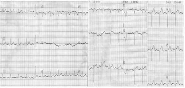 Fig. 1. Initial ECG showed intermittent ventricular premature complexes and diffuse non-specific ST segment changes