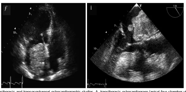 Fig. 5. Visible feeding vascularization originating from the right coronary artery (arrows), strongly suggestive of cardiac myxoma.