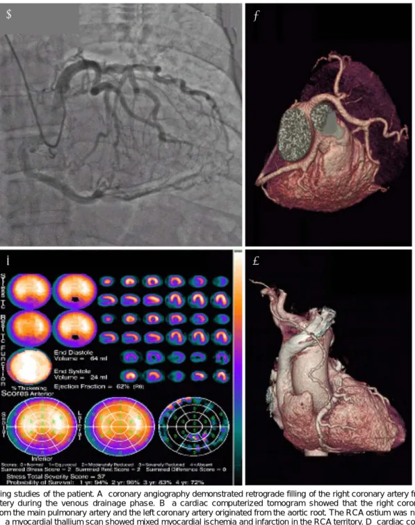 Fig. 1. Imaging studies of the patient. A: coronary angiography demonstrated retrograde filling of the right coronary artery from the left coronary artery during the venous drainage phase