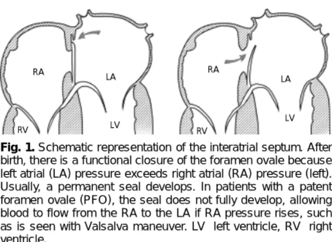 Fig. 1. Schematic representation of the interatrial septum. After birth, there is a functional closure of the foramen ovale because left atrial (LA) pressure exceeds right atrial (RA) pressure (left)