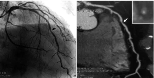 Fig. 3.  Multislice CT (right) and coronary angiographic view of LAD artery. Arrow indicate insignificant stenosis of mid LAD artery in angiography, but MSCT shows significant plaque burden of same site