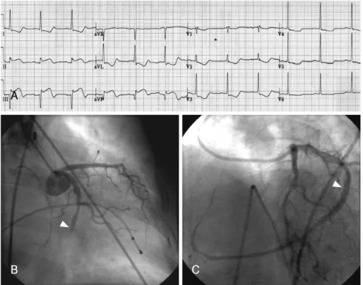 Fig. 1.  Acute right ventricular myocardial infarction due to occlusion of a single coronary artery
