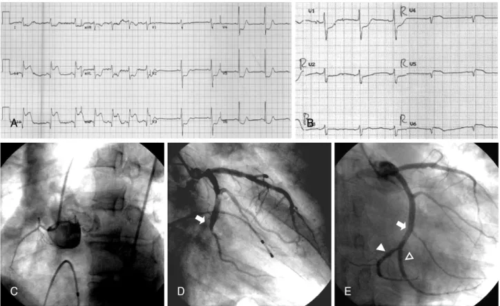 Fig. 2.  Acute right ventricular myocardial infarction due to occlusion of the left circumflex coronary artery, with a hypoplastic right coronary artery.