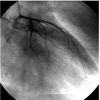 Fig. 2.   A coronary angiography after the implantation of sirolimus- sirolimus-eluting stents showed minimal residual stenosis
