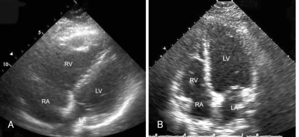 Fig. 1.  Transthoracic echocardiograms in the apical 4-chamber view, both before and after the thrombolysis