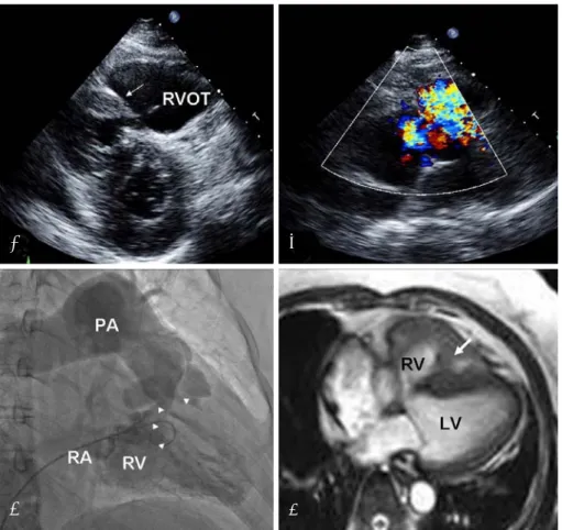 Fig. 1.  The two dimensional (2D) echocardiography, right ventriculogram and MR imaging of the isolated double-chambers of the right ventricle