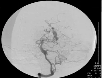 Fig. 4.  Pathologic examination of her breast lesions showed fibroade- fibroade-nomas with abundant myxoid changes at H &amp; E staining