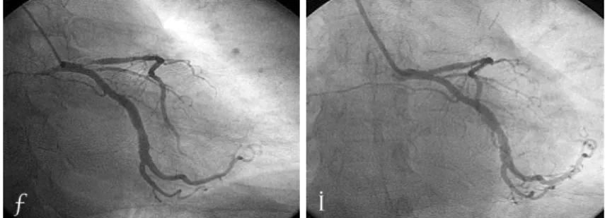 Fig. 4.  The follow-up coronary angiograms, six months after CBA, showed 30% ISR of the previously CBA segment of the proximal LAD