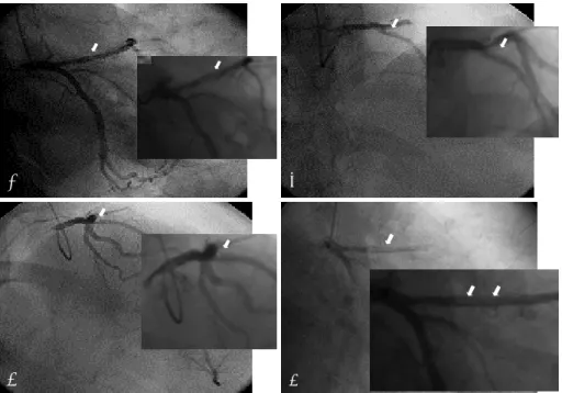 Fig. 5.   The electrocardiogram showed regular sinus rhythm with Q- Q-wave and ST segment elevation in precordial leads V1-4 at 880 days after stent deployment