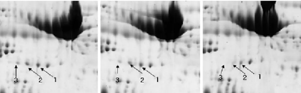 Fig. 2.  Patterns of fibrinogen gamma chain isoforms of plasma in patients with acute coronary syndrome and control