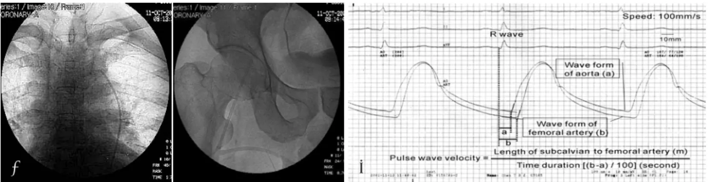 Fig. 1.  A 5 Fr. Judkins catheter was placed just distal to the origin of the left subclavian artery