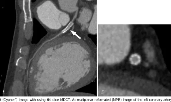 Fig. 1. Stent  (Cypher ® ) image with using 64-slice MDCT. A:  multiplanar reformated (MPR) image of the left coronary artery clearly de- de-monstrates the in-stent lumen and the internal enhancing vessel (arrow)