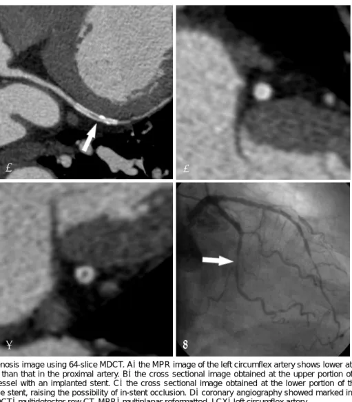 Fig. 2. In-stent restenosis image using 64-slice MDCT. A :  the MPR image of the left circumflex artery shows lower attenuation inside the  stent lumen (arrow) than that in the proximal artery