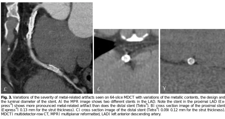 Fig. 3. Variations of the severity of metal-related artifacts seen on 64-slice MDCT with variations of the metallic contents, the design and  the luminal diameter of the stent