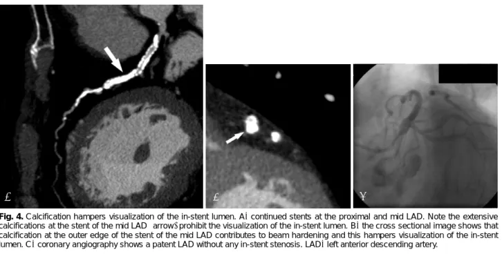 Fig. 4. Calcification hampers visualization of the in-stent lumen. A :  continued stents at the proximal and mid LAD
