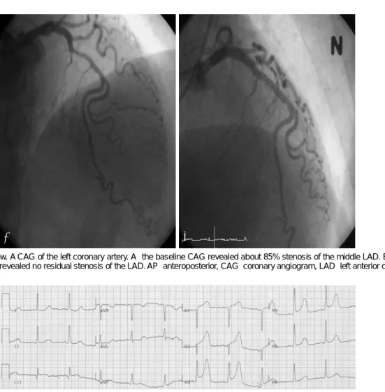 Fig. 2. AP cranial view. A CAG of the left coronary artery. A: the baseline CAG revealed about 85% stenosis of the middle LAD
