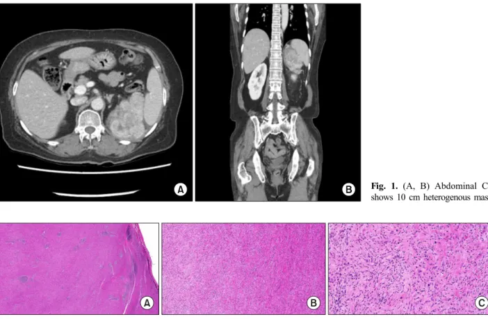 Fig. 1. (A, B) Abdominal CT  shows 10 cm heterogenous mass.