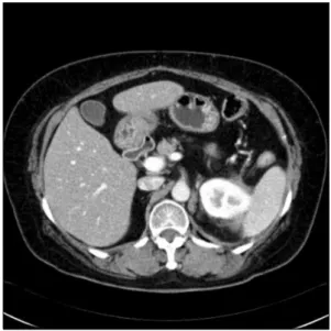 Fig. 4. Initial abdominal CT (A,  B), MRI (C) and PET (D)  images show 7.5 cm mass in  the head of pancreas.