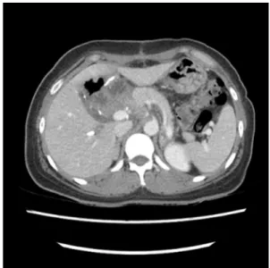 Fig. 6. After 6 month, no evidence of recurrence is observed  in the CT.