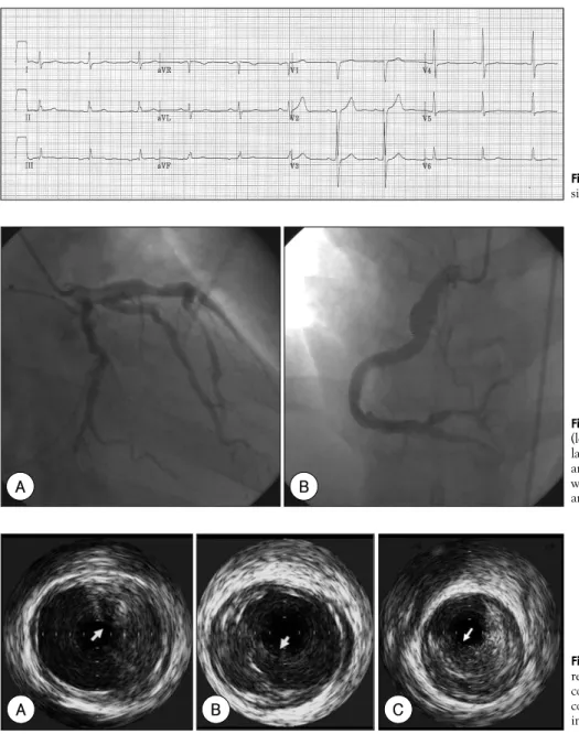 Fig. 1.  Electrocardiogram showing normal sinus rhythm and the Q wave in V 1 . 