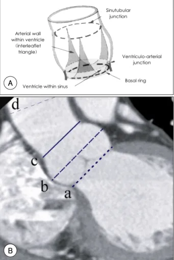 Fig. 1.  Measurement of aortic root using MDCT. A: schematic illu- illu-stration showing structures of aortic root