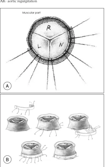 Fig. 2.  Schematic illustrations showing annulus reduction. A: the annu- annu-lus reduction at the level of fibrous portion