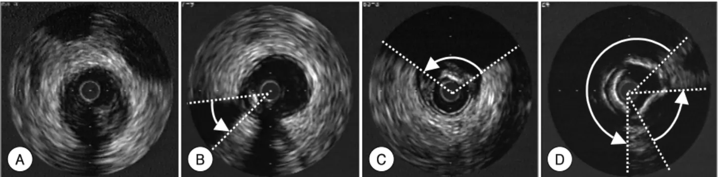 Fig. 1.  Measurement of the maximum arc of calcium on the most severely calcified image slices of the target lesions with using a protractor centered on the lumen