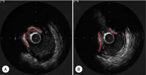 Table 1.  Patients’ characteristics according to target lesion calcium  Variables  No TLC (n=16)  TLC (n=49)  p  Age (yrs)  057±13 63±9 0.093*  Female gender (%)  4 (25)  15 (31)  0.361*  BMI (Kg/m 2 ) 25.5±2.3 24.8±2.8 0.381*  DM (%)  1 (06) 14  (29)  0.0