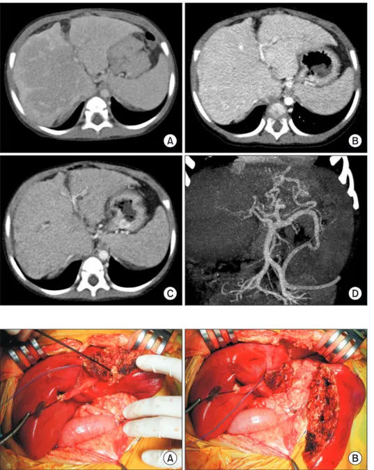 Fig. 1. Pretransplant computed tomography  (CT) taken at 1 year (A), 6 months (B), and 1  month (C) before transplantation showing  progression of liver cirrhosis