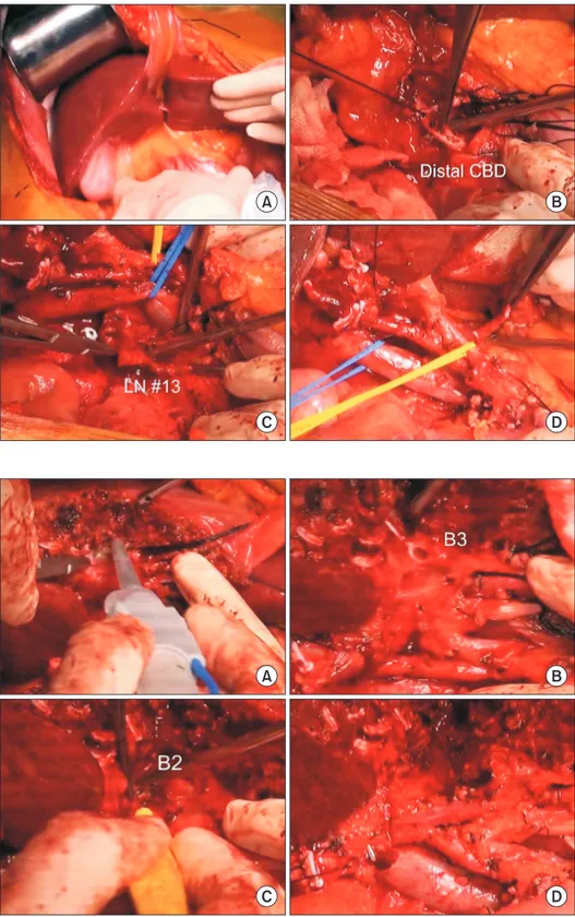 Fig. 2. Intraoperative photographs showing  dissection of the hepatoduodenal ligament