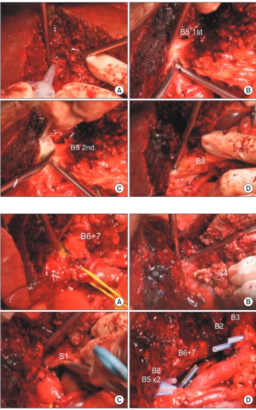 Fig. 5. Intraoperative photographs showing  right liver transection. Conjoined segments  VI and VII duct (B6 + 7) is transected (A)