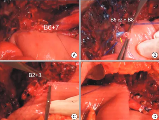 Fig. 6. Intraoperative photographs showing  biliary reconstruction. Segments VI and  VII duct (B6 + 7) is reconstructed through  a single hepaticojejunostomy (HJ) (A)