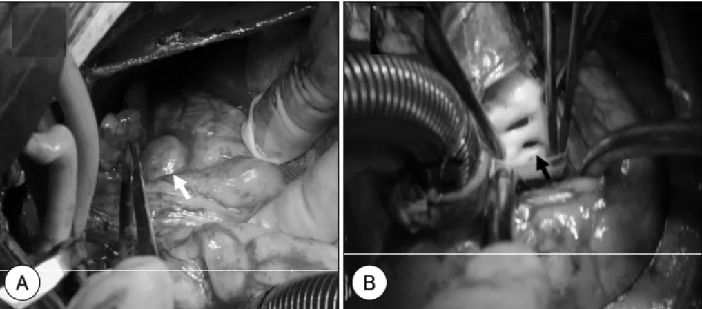 Fig. 4.  The unruptured saccular aneurysm (2.5×2.4 cm in diameter) arose from the central part of the left coronary sinus