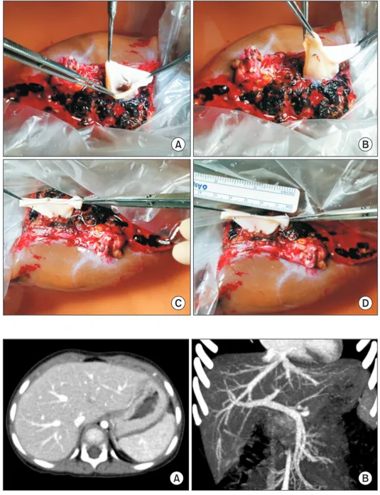 Fig. 4. Intraoperative photographs of bench  work. (A–C) An inferior vena cava fragment  homograft is attached to the graft hepatic  vein orif ice to make a funnel-shaped  conduit