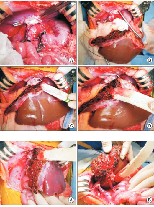 Fig. 7. Intraoperative photographs of left  lateral section graft implantation. (A) The  hepatic vein reconstruction is located  at the orthodox position
