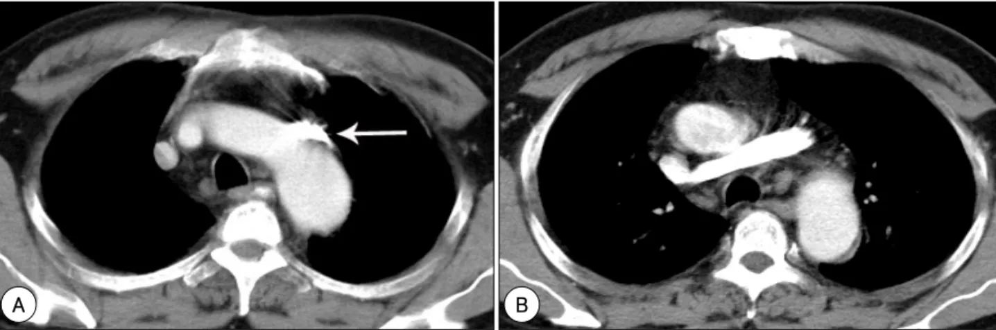 Fig. 2.  Sequential contrast-enhanced chest CT scans show a contrast-filled anomalous brachiocephalic vein (arrows) lateral to the aortic arch (A).