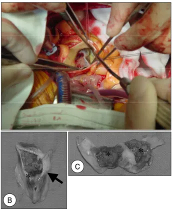 Fig. 2.  Operative findings. The aortic valvular mass was viewed from the ascending aorta in the operative field (A)