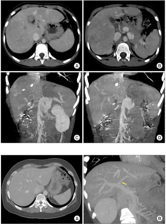 Fig. 1. Pretransplant computed tomography  findings of the recipient. (A, B) Multiple  liver tumors can be seen