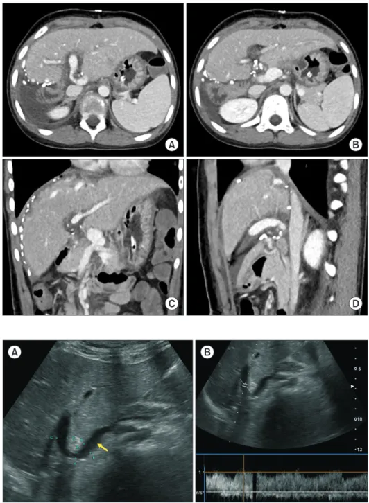 Fig. 8. Posttransplant computed tomo- tomo-graphy scan taken at four days after the  transplantation
