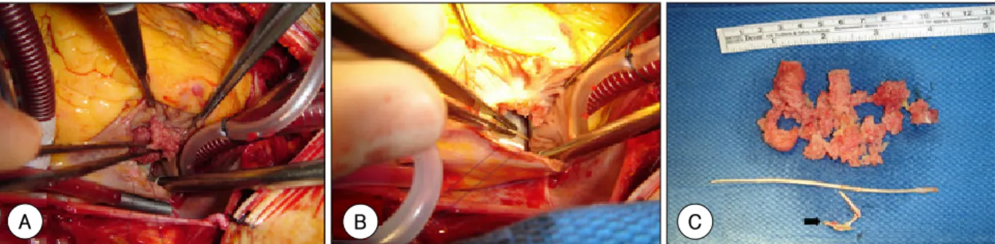 Fig. 3.  Open heart surgery and gross specimens. The thrombus (A) and acrylic cement foreign bodies (B) removed by right atriotomy
