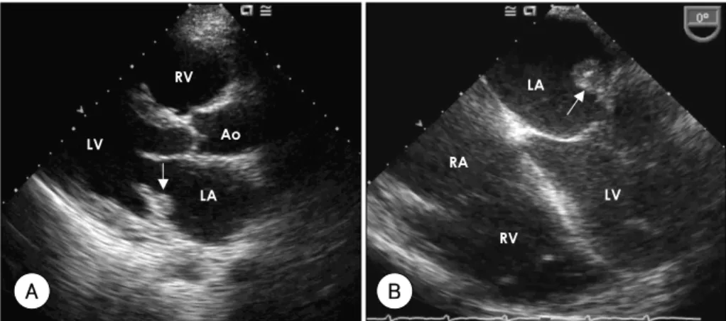 Fig. 1.  Photograph of the transthoracic echocardiogram showing the parasternal long axis view of a 1 cm sized, round shaped, echogenic mass in the left atrium (arrow) (A)