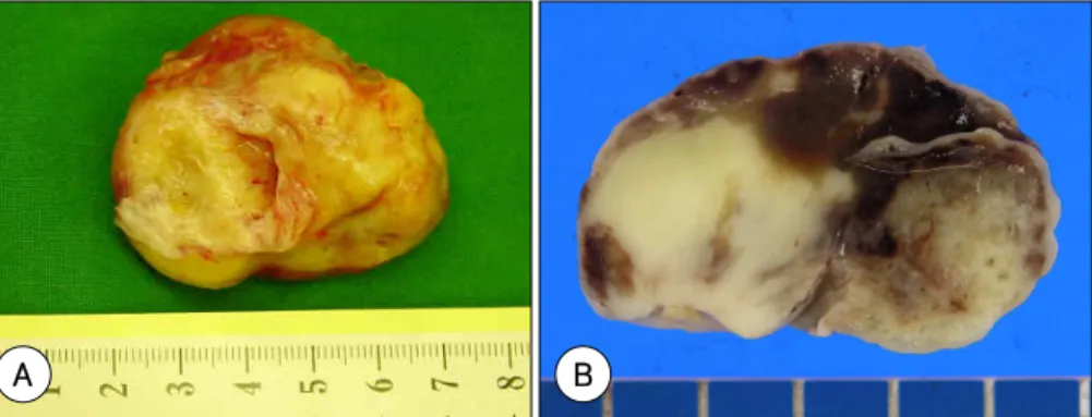 Fig. 3.  The left atrium mass measured 31.5 g in weight and 5.1×4.2×3.0 cm in size. The outer surface was pale yellow to grayish brown with a slightly lobulated contour (A)