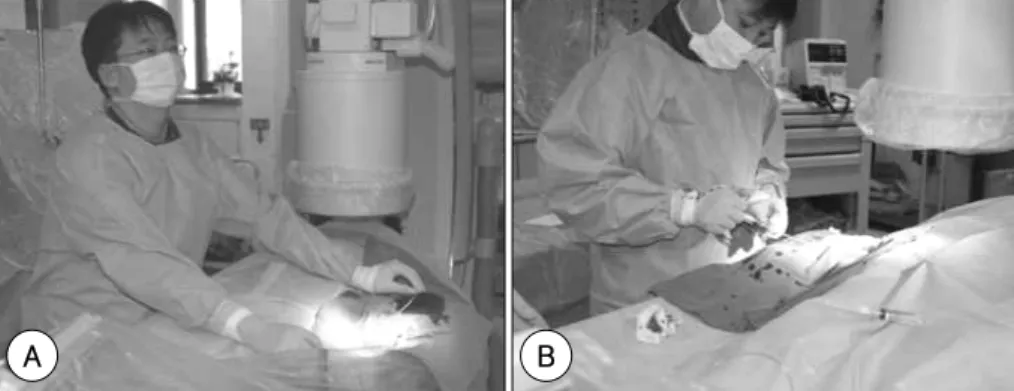 Fig. 2.  Procedural position of the right and left radial approaches. A: left radial approach, B: right radial approach