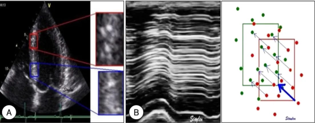 Fig. 1.  The longitudinal peak strain and strain rate were obtained from 2 different areas of the basal segments of the LA free wall and the inter-atrial septum in the apical 4 chamber view by using the tissue Doppler strain (A, B), the mean peak systolic 