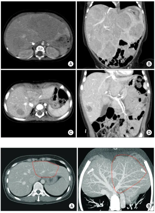 Fig. 1. Pretransplant computed tomography  findings of the recipient. At five months  before the liver transplantation operation,  huge multiple tumors occupied the whole  liver