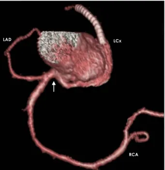 Fig. 2.  Multi-detector computed tomography coronary angiography showing all 3 vessels arising from the right coronary sinus (arrow).