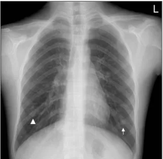 Fig. 1.  Chest X-ray shows 3 cm sized well demarcated lobular mass in right lower lung field (arrow head) and 1 cm sized nodule in left lower lung field (arrow)